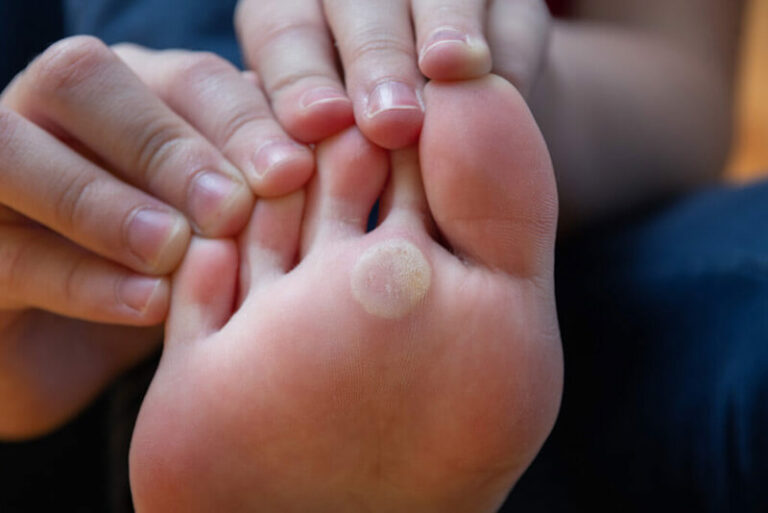 Symptoms-of-foot-corns-&-callus